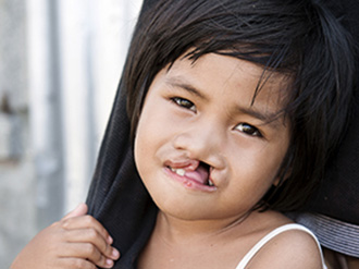 young girl smiling with cleft lip, Operation Smile